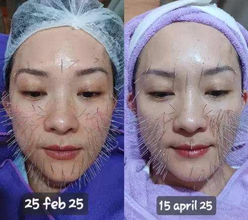 Pasien Susan Health & Beauty Center 06