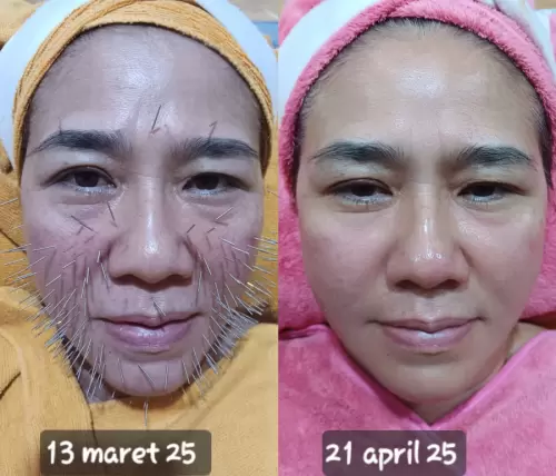 Pasien Susan Health & Beauty Center 07