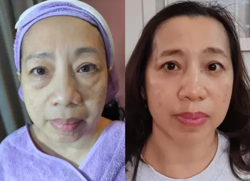 Pasien Susan Health & Beauty Center 13