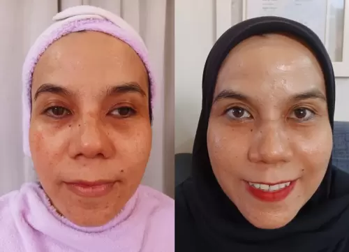 Pasien Susan Health & Beauty Center 14